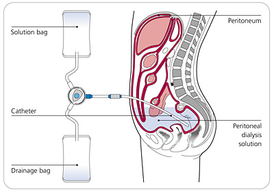 Dialysis