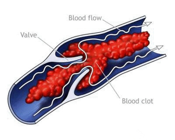 Blood Pollution Therapy