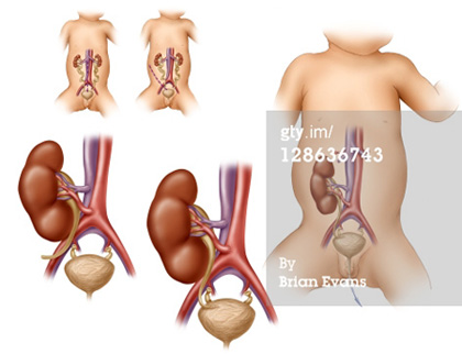 Kidney Transplant