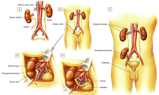 Kidney Transplant