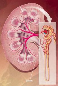 Glomerulonephritis