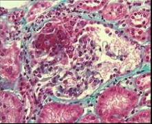What is IgA Nephropathy