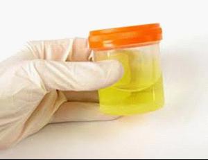 Symptoms of Focal Segmental Glomerulosclerosis(FSGS)