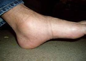 Symptoms of Nephrotic Syndrome