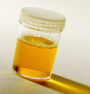 Causes of Proteinuria, CKD Stage 4