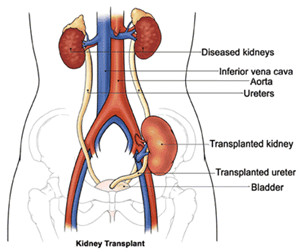 Kidney Transplant