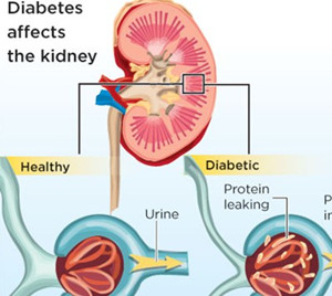 How Does High Blood Sugar Cause Diabetic Nephropathy