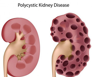 classification of PKD 
