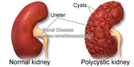 How Long Can I Live With Polycystic Kidney Disease