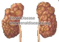 How to Stop Polycystic Kidney Disease to Kidney Failure