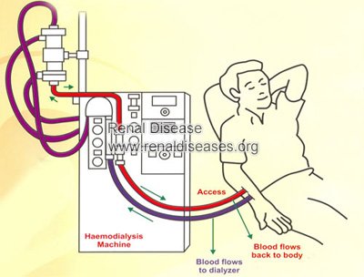 dialysis
