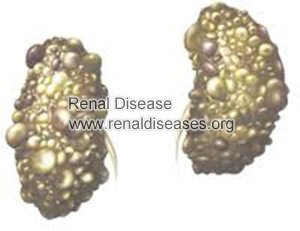 How Long Can I Live with PKD on Dialysis