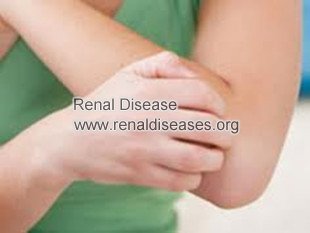 Dialysis: How to Deal with Itchy Skin with CKD On Dialysis