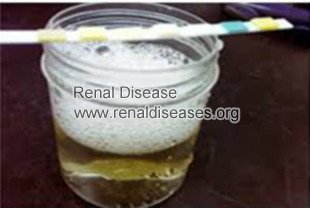 Natural Treatments for Proteinuria with Kidney Disease