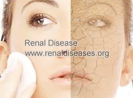 Dry Skin and End Stage Kidney Disease