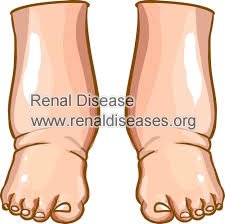 What are the Causes of Edema with Stage 4 Chronic Kidney Disease