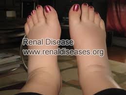 Feet Swelling Due to Kidney Disease