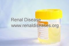 Natural Remedies to Reduce Protein in Urine with Nephrotic Syndrome