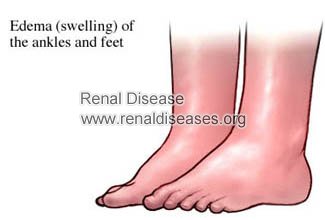 Feet swelling and FSGS