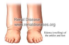 Feet Swelling and Stage 4 Kidney Disease