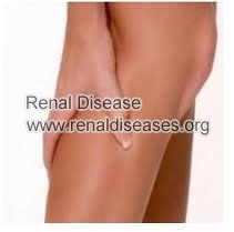 How to Avoid Muscle Cramps When I am On Dialysis