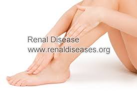 Will Leg Edema be Reduced after Dialysis