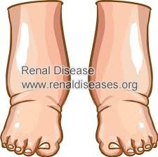How to Treat Leg Swelling in Stage 4 Kidney Disease