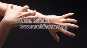 Stage 3 Chronic Kidney Disease: How to Relieve Itchy Skin