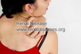 Can Natural Remedy Help Itchy Skin in FSGS