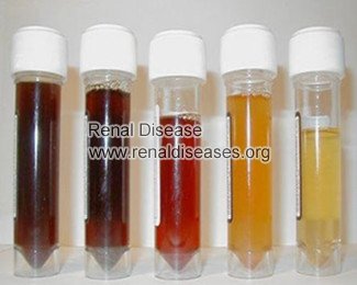 Hematuria in Glomerulonephritis: Causes and Treatments