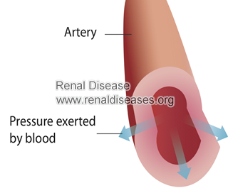 Top 6 Ways to Control High Blood Pressure in FSGS