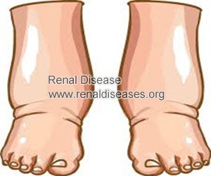 How Does Leg Swelling Occur in IgA Nephropathy