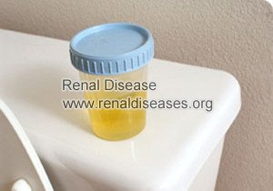 Stage 4 Kidney Failure: What Can I Do to Increase Urine Output