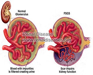 Top 4 Facts about FSGS