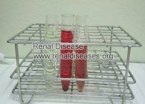 Hematuria in IgA Nephropathy: Causes and Treatments