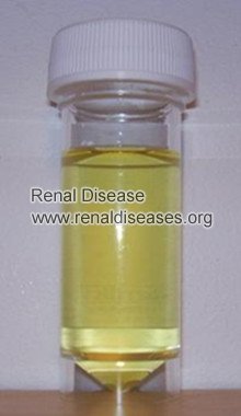 Treatments for Proteinuria in Children with Nephrotic Syndrome