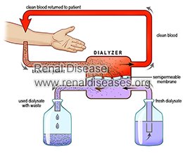 Is Dialysis A Better Choice for Kidney Failure
