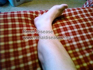 How Does Muscle Cramps Occur in Hemodialysis Patients