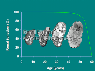 What Are the Stages of Polycystic Kidney Disease