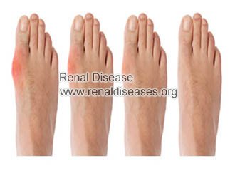 Chronic Kidney Disease And Gout