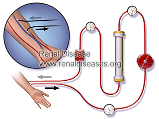 Common Problems Associated with Dialysis