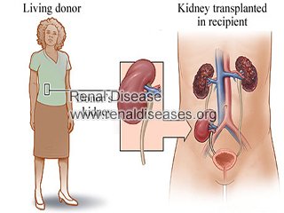 Top 3 Facts about Kidney Transplant