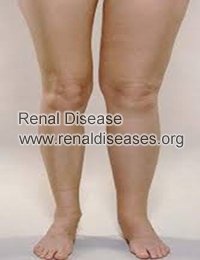 Leg Swelling in Lupus Nephritis: Causes And Treatments