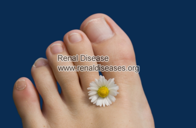 Diet for CKD Patients with Gout