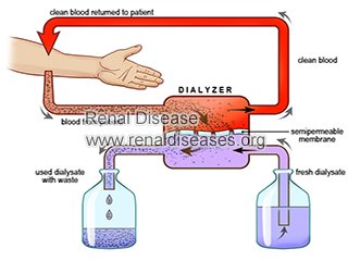 Is Hemodialysis Appropriate for Kidney Failure due to IgA Nephropathy