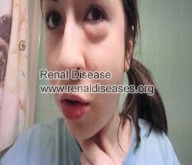 Causes and Treatments of Puffy Face in CKD