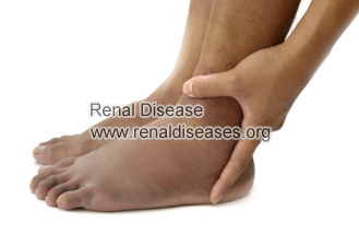 What Can You Do If You Have Severe Edema in Stage 4 Renal Failure