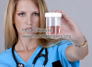 How to treat Blood Urine in Ruptured Kidney Cysts