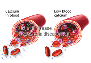 Hypocalcemia in Real Failure: Causes and Treatment
