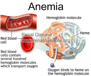 Anemia in Polycystic Kidney Disease: Causes and Treatment
